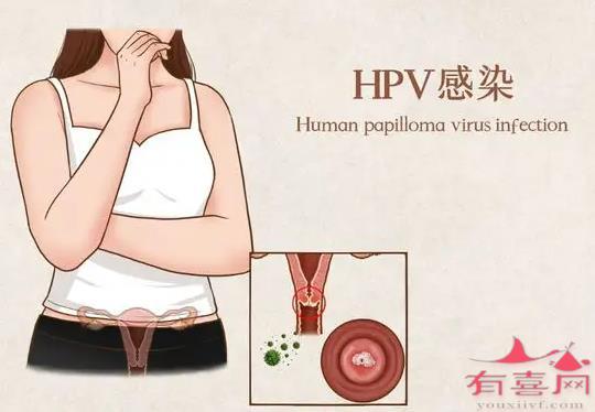 HPV病毒感染者