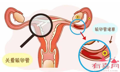 输卵管两侧不通只能做试管了吗