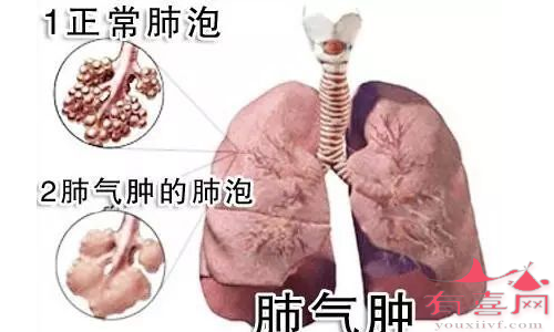 肺气肿是什么病