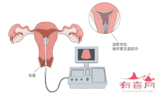 输卵管堵塞进行哪些检查