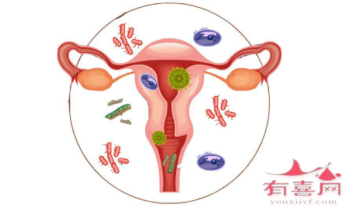 引起盆腔炎的因素很多，但多可预防