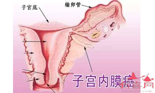 子宫内膜癌的早期症状是怎样的