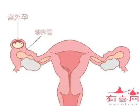 输卵管通而不畅可能会造成宫外孕