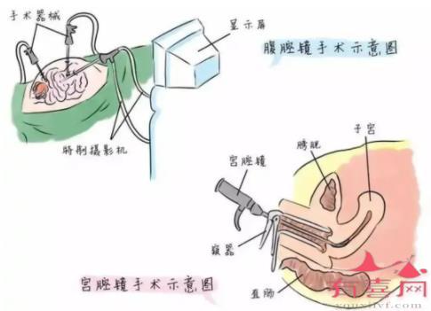 宫腔镜手术示意图