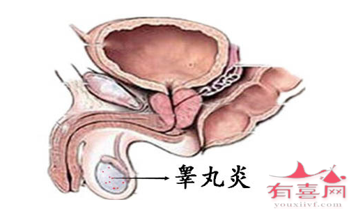 腮腺炎会导致睾丸炎