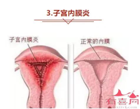 慢性子宫内膜炎