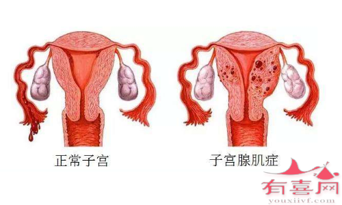 子宫腺肌症促排适合什么方案