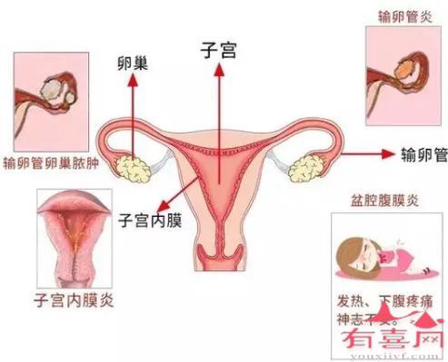 子宫内膜炎