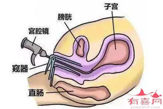 诊断子宫内膜炎的方法