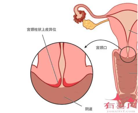 低级别鳞状上皮内病变常见治疗方法