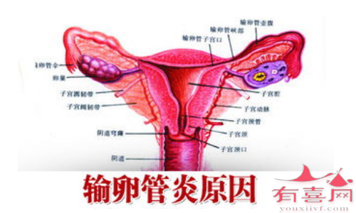 输卵管炎是什么原因引起的