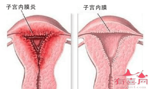 慢性子宫内膜炎的症状有哪些