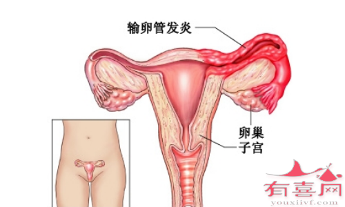 长期的输卵管炎扩散可引起慢性子宫内膜炎