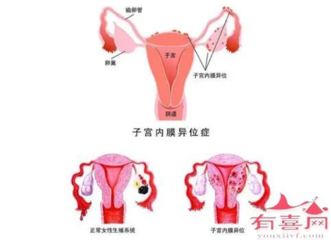 子宫内膜异位1到4期区别是什么