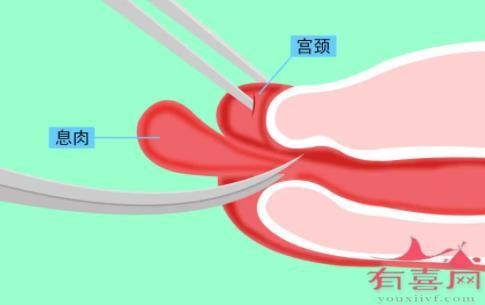 宫颈息肉一定要割吗