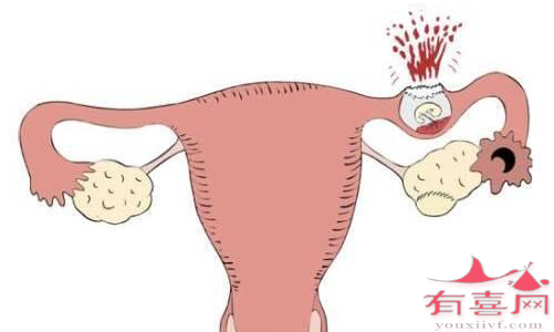 通而不畅的输卵管可能形成宫外孕