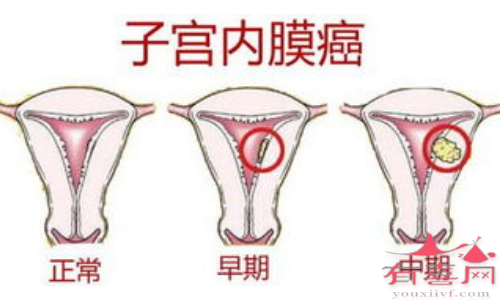 子宫恶性病变主要是子宫内膜癌