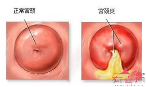 宫颈炎有2个明显症状是什么