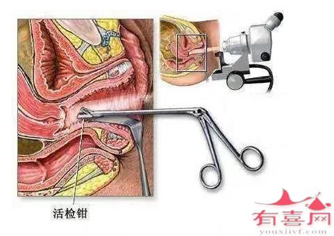 宫颈活检示意图