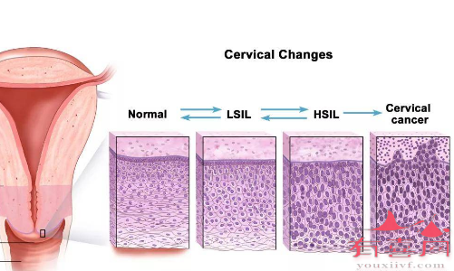 宫颈上皮鳞状病变对生育有影响