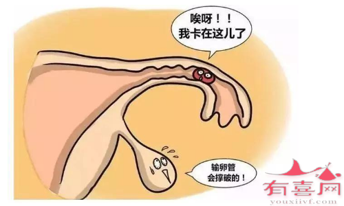 易导致不孕或危险宫外孕