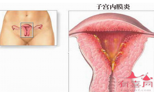 子宫内膜炎的初期症状有哪些