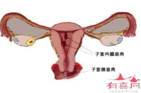 子宫内膜息肉影响排卵吗