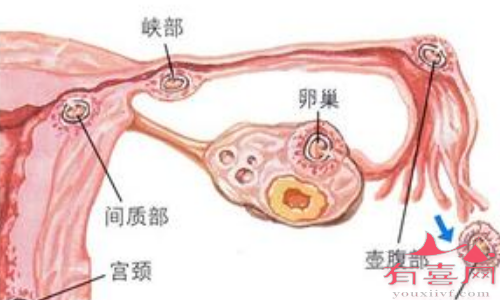 慢性输卵管炎影响怀孕吗