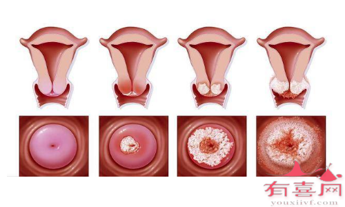 宫颈炎治疗费用因人而异