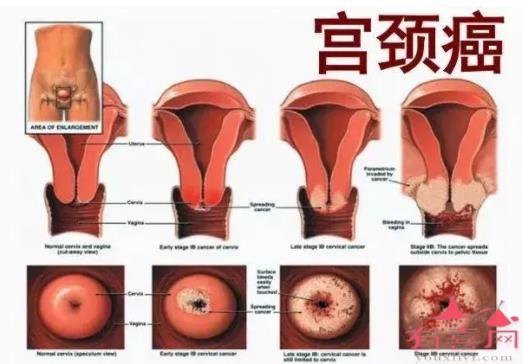 宫颈癌是什么原因导致的