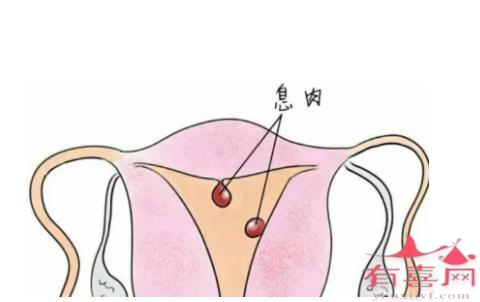 内膜息肉最快多久复发