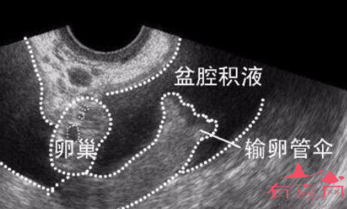 盆腔积液25mm严重吗