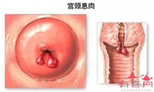 宫颈息肉不治疗要紧吗