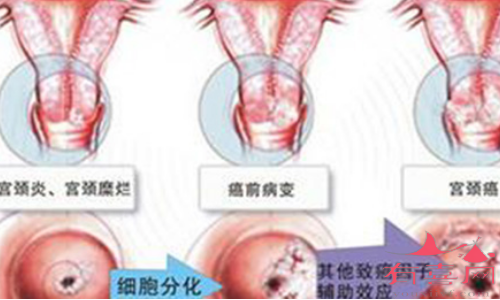 宫颈息肉有癌变的可能