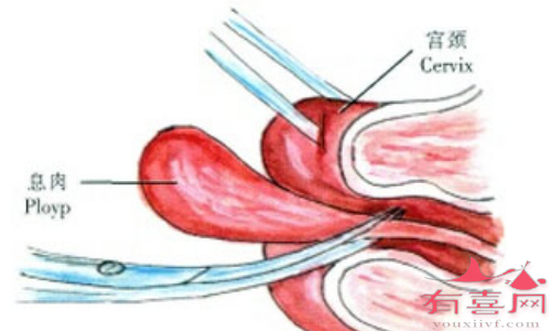 宫颈息肉如何治疗