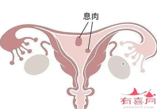 子宫内膜息肉可以怀孕吗