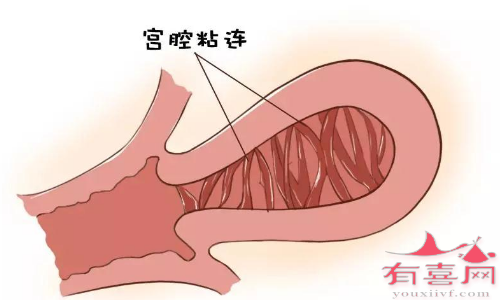 宫腔粘连会自己自动恢复吗