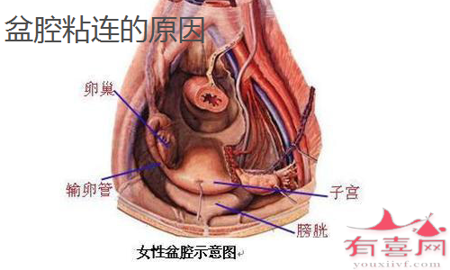 盆腔粘连是什么原因造成的