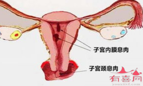 宫颈息肉手术后需要注意什么