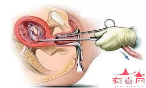 宫腔粘连术后怎么预防再次粘连