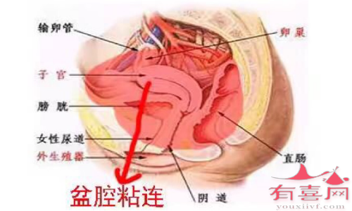 盆腔粘连能怀上孩子吗