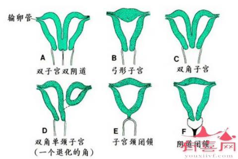 残角子宫切除后多久可以怀孕