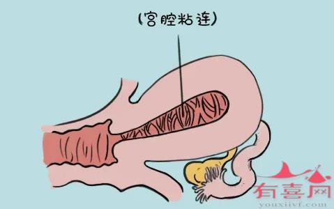 宫腔粘连能怀上孩子吗