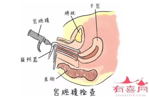 宫腔粘连的自检方法