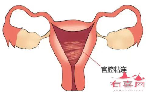 怎样确定子宫有没有粘连啊