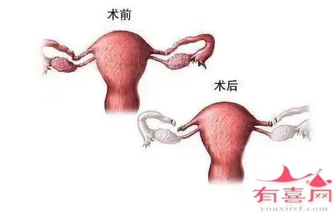 子宫卵巢输卵管全切除了对身体的伤害