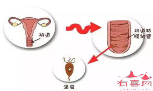 有滴虫性阴炎容易怀孕吗