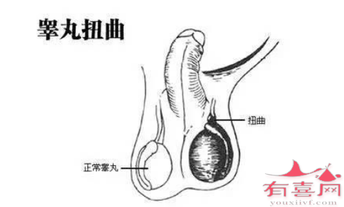 隐睾可能导致的并发症有哪些