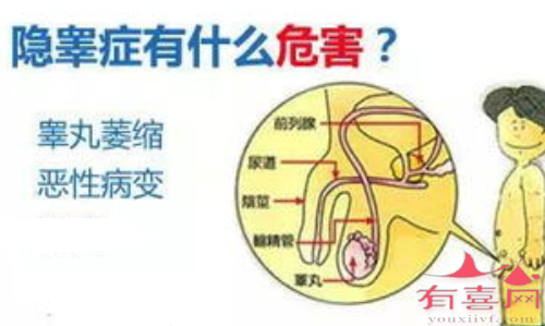 隐睾对男性的影响