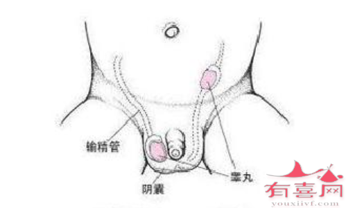 隐睾导致无精症能做试管婴儿吗